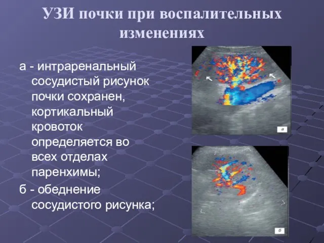 УЗИ почки при воспалительных изменениях а - интраренальный сосудистый рисунок почки