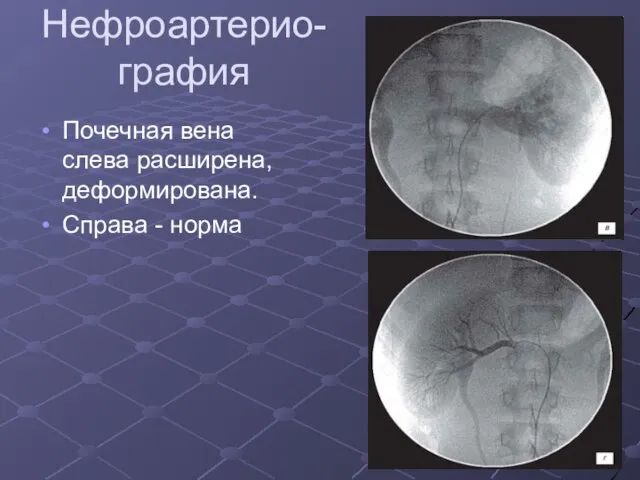Нефроартерио- графия Почечная вена слева расширена, деформирована. Справа - норма