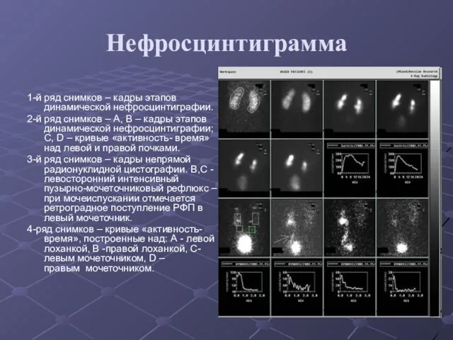 Нефросцинтиграмма 1-й ряд снимков – кадры этапов динамической нефросцинтиграфии. 2-й ряд
