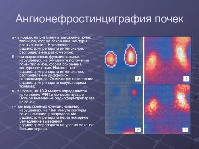 Ангионефростинциграфия почек а - в норме, на 5-й минуте положение почек