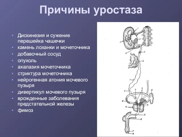 Причины уростаза Дискинезия и сужение перешейка чашечки камень лоханки и мочеточника