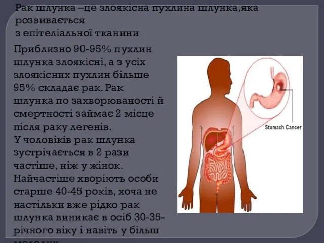 Рак шлунка –це злоякісна пухлина шлунка,яка розвивається з епітеліальної тканини Приблизно