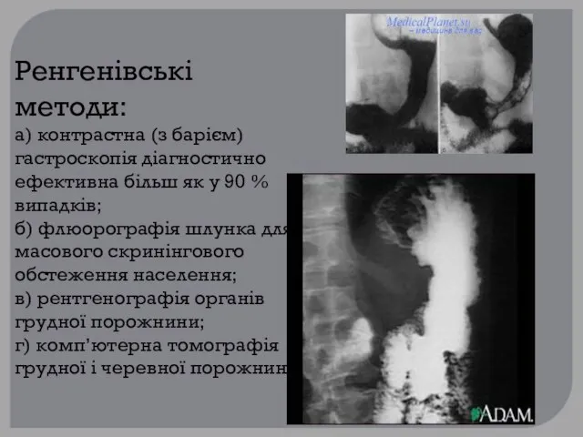 Ренгенівські методи: а) контрастна (з барієм) гастроскопія діагностично ефективна більш як