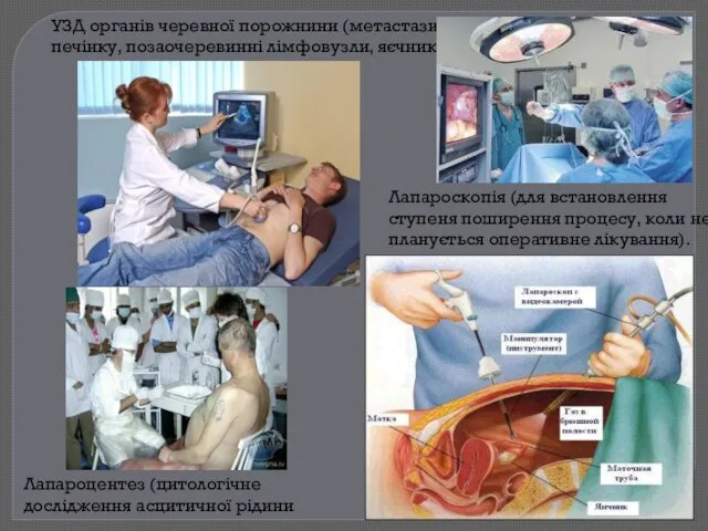 УЗД органів черевної порожнини (метастази в печінку, позаочеревинні лімфовузли, яєчники). Лапароскопія