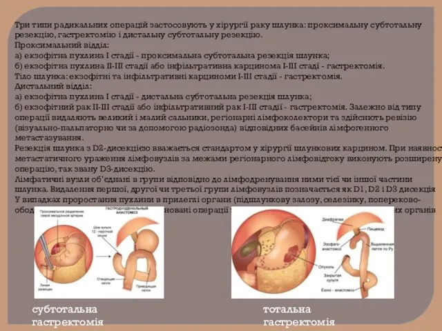 Три типи радикальних операцій застосовують у хірургії раку шлунка: проксимальну субтотальну