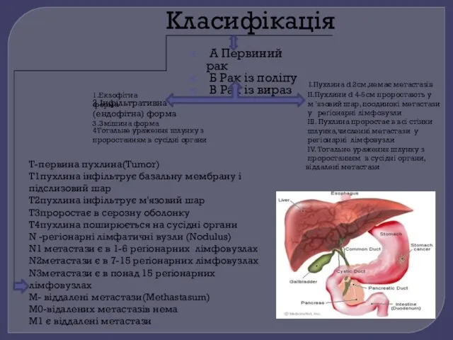 Класифікація А Первиний рак Б Рак із поліпу В Рак із