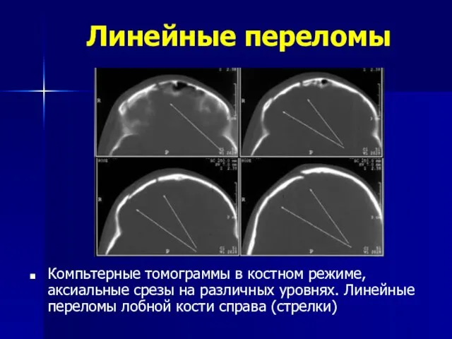 Линейные переломы Компьтерные томограммы в костном режиме, аксиальные срезы на различных