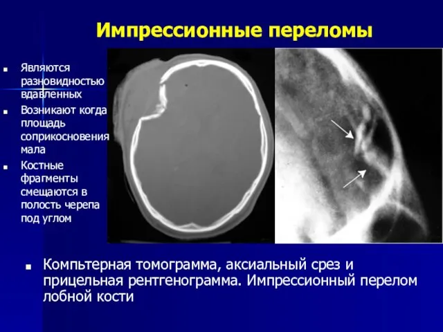 Импрессионные переломы Компьтерная томограмма, аксиальный срез и прицельная рентгенограмма. Импрессионный перелом