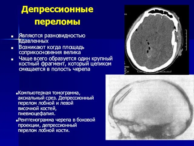 Депрессионные переломы Являются разновидностью вдавленных Возникают когда площадь соприкосновения велика Чаще