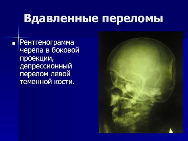 Вдавленные переломы Рентгенограмма черепа в боковой проекции, депрессионный перелом левой теменной кости.