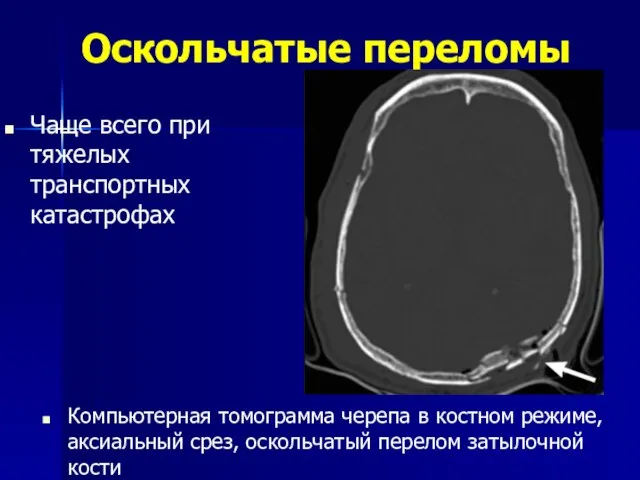 Оскольчатые переломы Чаще всего при тяжелых транспортных катастрофах Компьютерная томограмма черепа