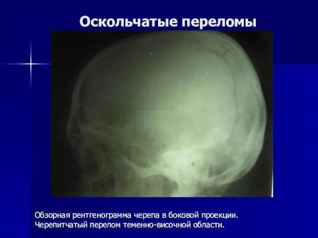 Оскольчатые переломы Обзорная рентгенограмма черепа в боковой проекции. Черепитчатый перелом теменно-височной области.