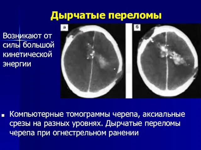 Дырчатые переломы Возникают от силы большой кинетической энергии Компьютерные томограммы черепа,