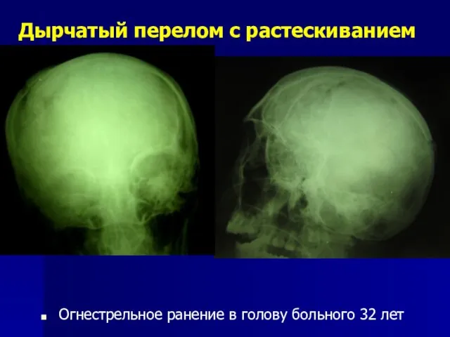 Дырчатый перелом с растескиванием Огнестрельное ранение в голову больного 32 лет