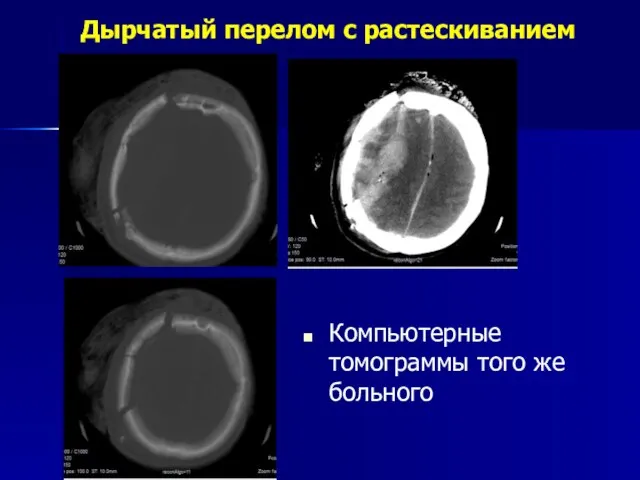 Дырчатый перелом с растескиванием Компьютерные томограммы того же больного