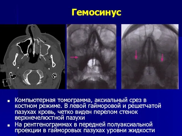 Гемосинус Компьютерная томограмма, аксиальный срез в костном режиме. В левой гайморовой