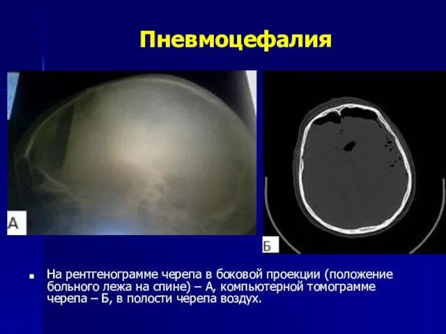 Пневмоцефалия На рентгенограмме черепа в боковой проекции (положение больного лежа на