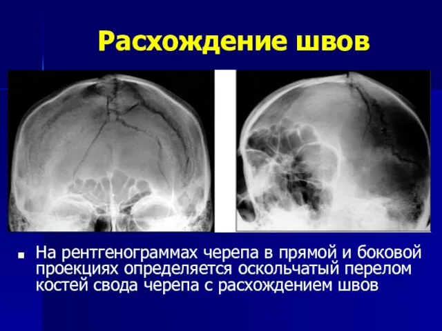 Расхождение швов На рентгенограммах черепа в прямой и боковой проекциях определяется