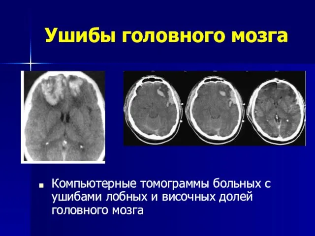 Ушибы головного мозга Компьютерные томограммы больных с ушибами лобных и височных долей головного мозга