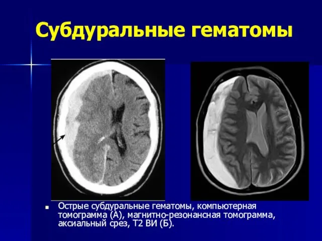 Субдуральные гематомы Острые субдуральные гематомы, компьютерная томограмма (А), магнитно-резонансная томограмма, аксиальный срез, Т2 ВИ (Б).