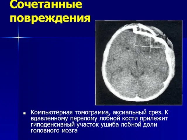 Сочетанные повреждения Компьютерная томограмма, аксиальный срез. К вдавленному перелому лобной кости