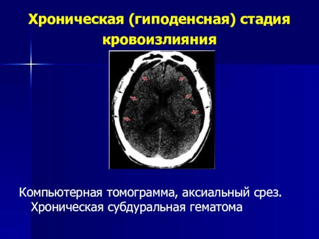 Хроническая (гиподенсная) стадия кровоизлияния Компьютерная томограмма, аксиальный срез. Хроническая субдуральная гематома