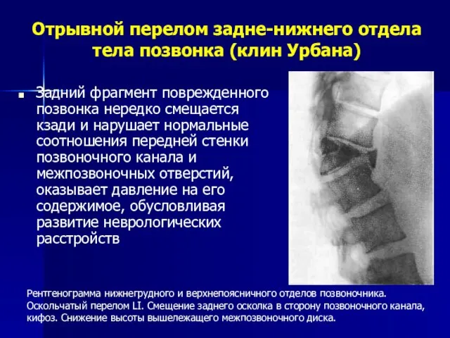 Отрывной перелом задне-нижнего отдела тела позвонка (клин Урбана) Задний фрагмент поврежденного