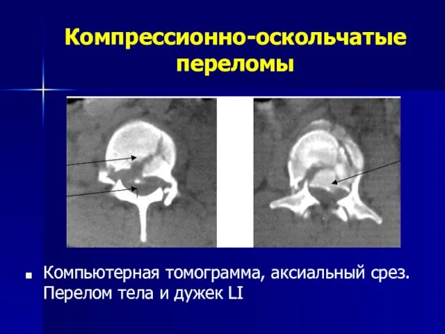 Компрессионно-оскольчатые переломы Компьютерная томограмма, аксиальный срез. Перелом тела и дужек LI