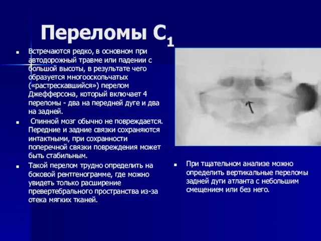 Переломы С1 Встречаются редко, в основном при автодорожный травме или падении