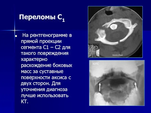 Переломы С1 На рентгенограмме в прямой проекции сегмента С1 – С2