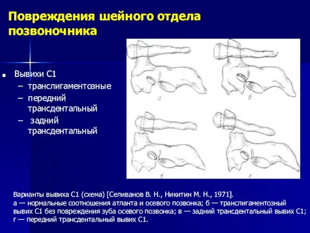 Повреждения шейного отдела позвоночника Варианты вывиха C1 (схема) [Селиванов В. Н.,