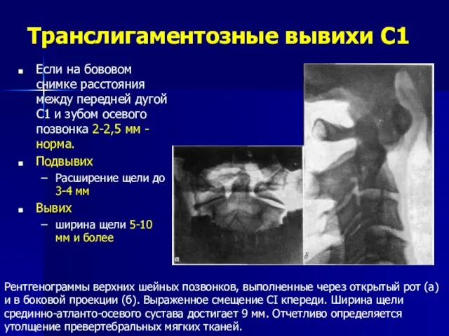 Транслигаментозные вывихи С1 Рентгенограммы верхних шейных позвонков, выполненные через открытый рот