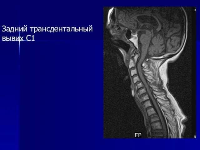 Задний трансдентальный вывих C1