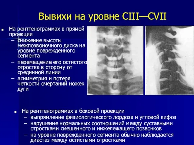 Вывихи на уровне CIII—CVII На рентгенограммах в прямой проекции снижение высоты