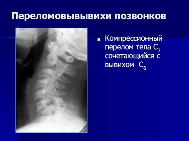 Переломовывывихи позвонков Компрессионный перелом тела С7 сочетающийся с вывихом С6