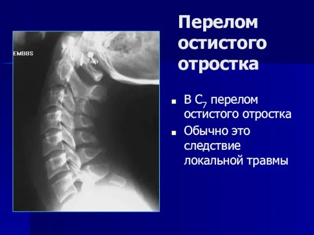 Перелом остистого отростка В С7 перелом остистого отростка Обычно это следствие локальной травмы