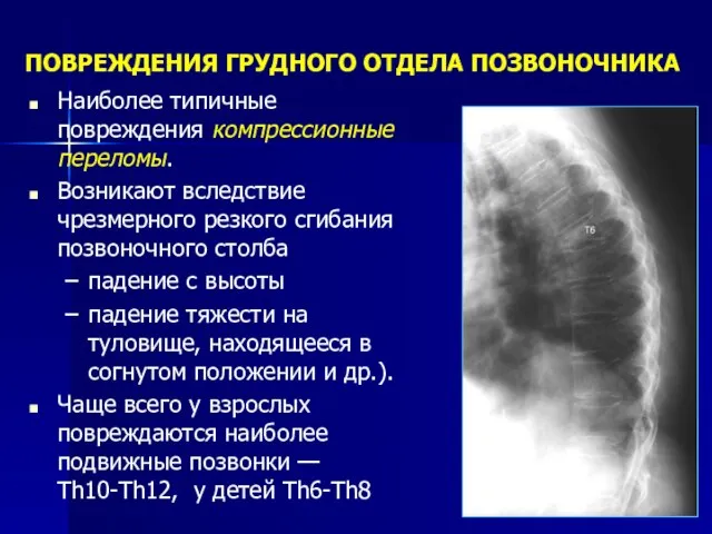 ПОВРЕЖДЕНИЯ ГРУДНОГО ОТДЕЛА ПОЗВОНОЧНИКА Наиболее типичные повреждения компрессионные переломы. Возникают вследствие