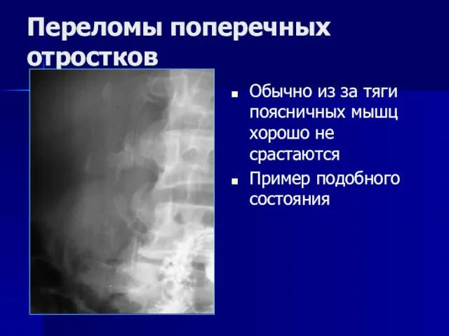 Переломы поперечных отростков Обычно из за тяги поясничных мышц хорошо не срастаются Пример подобного состояния