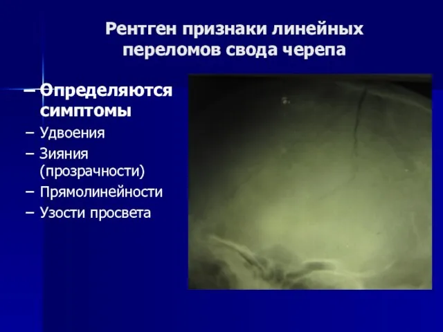 Рентген признаки линейных переломов свода черепа Определяются симптомы Удвоения Зияния (прозрачности) Прямолинейности Узости просвета