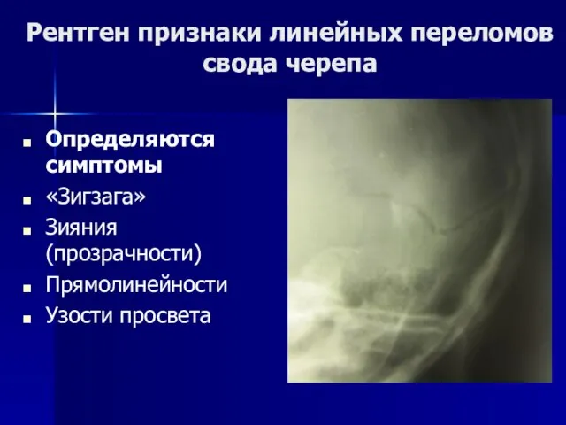 Рентген признаки линейных переломов свода черепа Определяются симптомы «Зигзага» Зияния (прозрачности) Прямолинейности Узости просвета