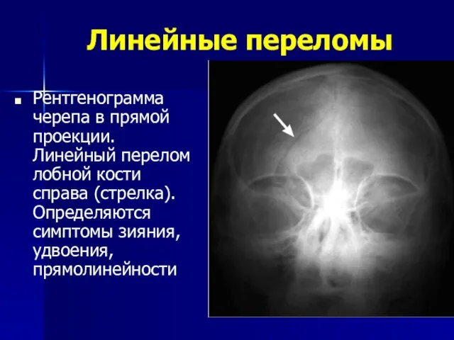 Линейные переломы Рентгенограмма черепа в прямой проекции. Линейный перелом лобной кости