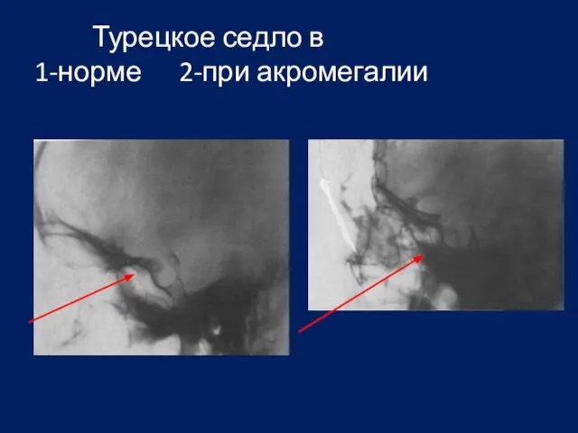 Турецкое седло в 1-норме 2-при акромегалии