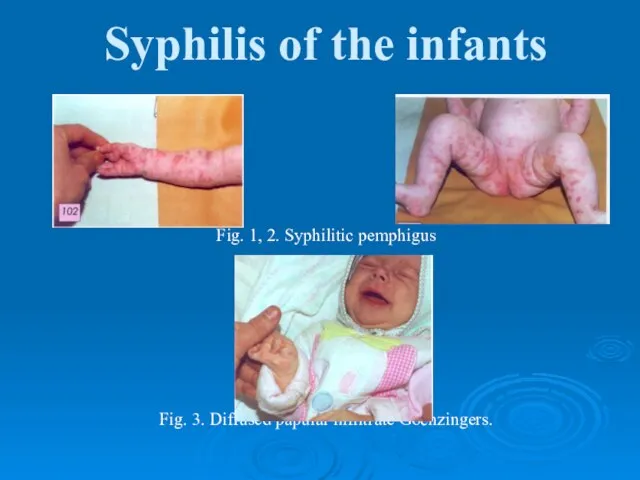 Syphilis of the infants Fig. 1, 2. Syphilitic pemphigus Fig. 3. Diffused papular infiltrate Gochzingers.