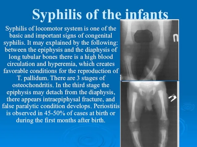 Syphilis of the infants Syphilis of locomotor system is one of