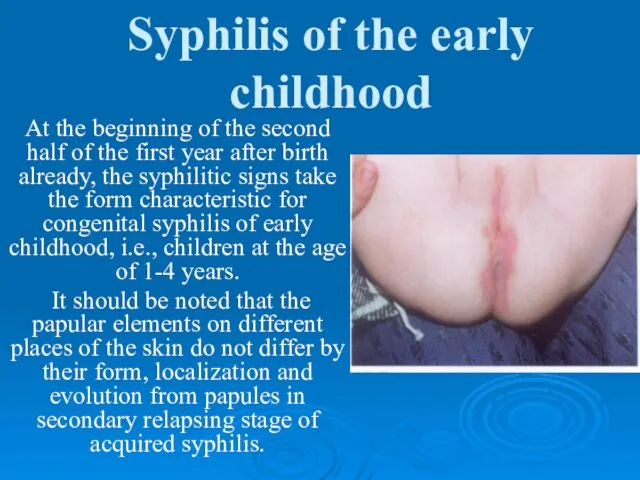 Syphilis of the early childhood At the beginning of the second