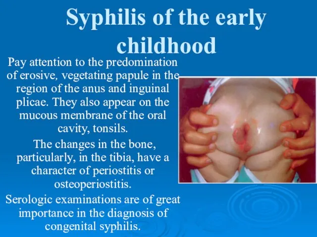 Syphilis of the early childhood Pay attention to the predomination of