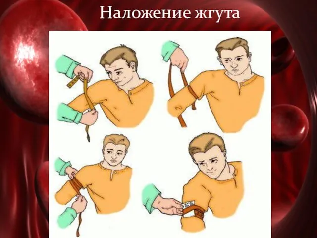 Наложение жгута