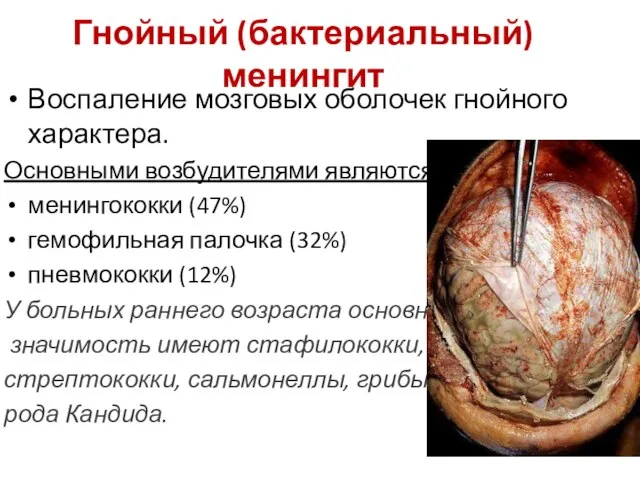 Гнойный (бактериальный) менингит Воспаление мозговых оболочек гнойного характера. Основными возбудителями являются: