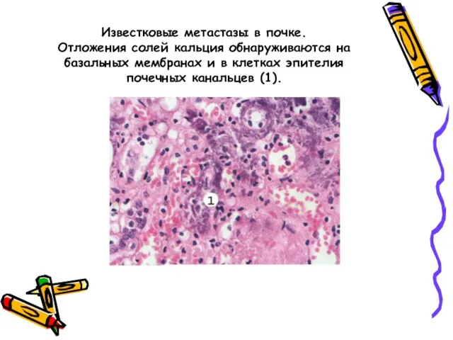 Известковые метастазы в почке. Отложения солей кальция обнаруживаются на базальных мембранах