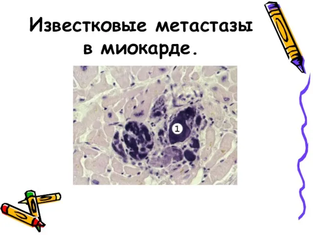 Известковые метастазы в миокарде.